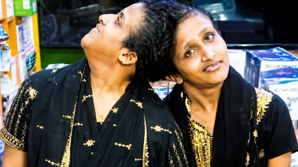 Patna News Saba and Farah receive essential medicines after three months; a team of specialist doctors will now conduct health check-ups every month.