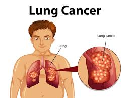 Lung cancer: Causes, symptoms and habits that increase your risk