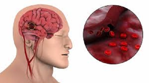 Pollution increases the risk of blood clotting in veins by 100%, it can be fatal for heart and brain