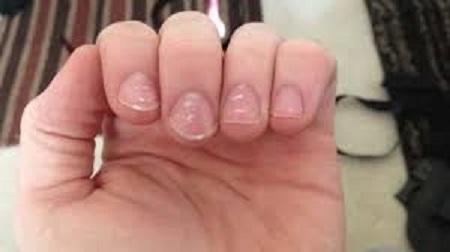 White spots on nails: May be a sign of deficiency of these vitamins and minerals