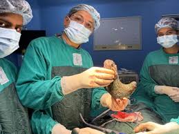Raxaul: A shocking case has come to light at the hospital; a 1.5 kg ball of hair was removed from a woman's stomach.